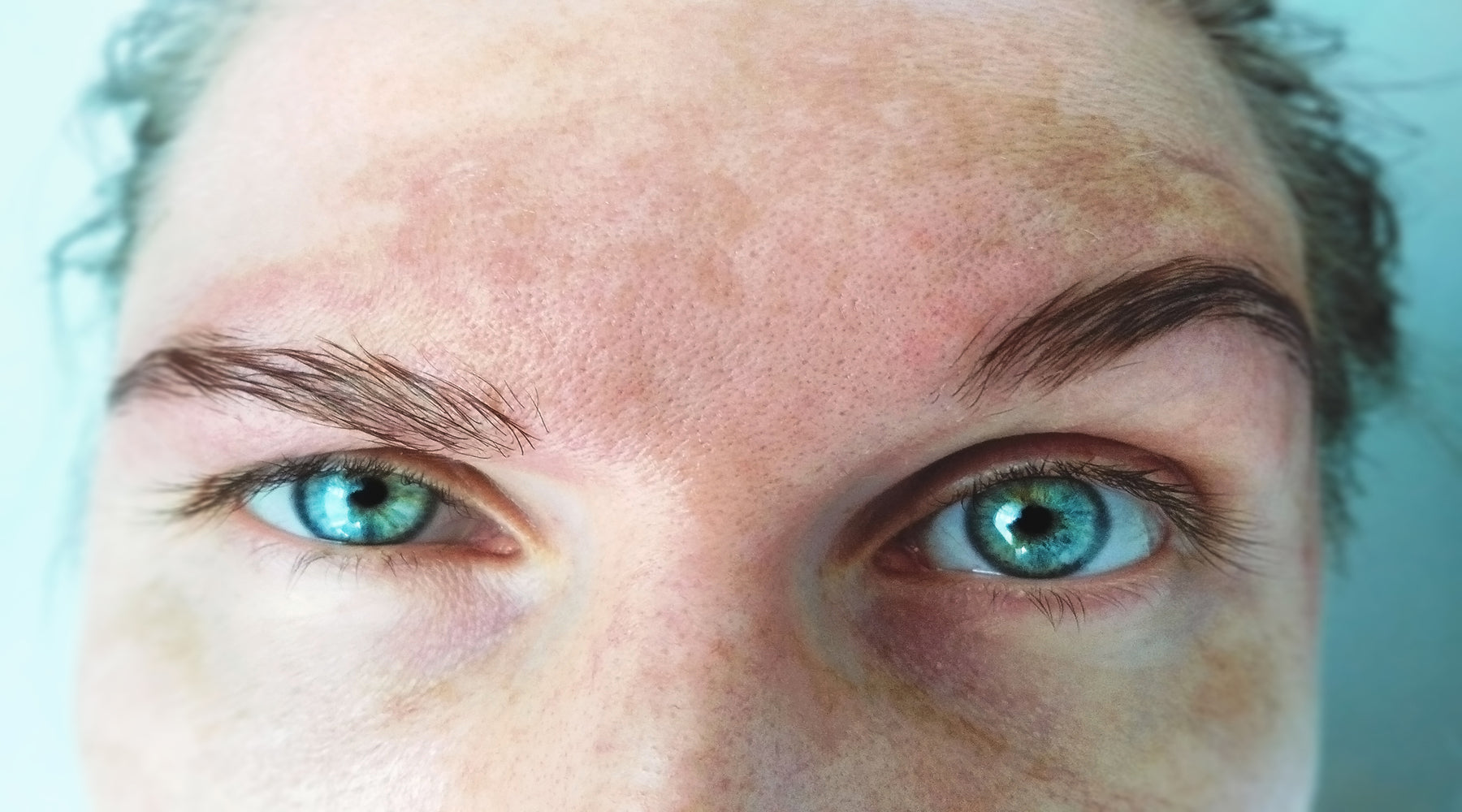 Woman with melasma looking at camera.