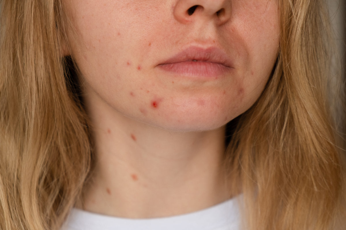 Close-up of an adult woman's chin, jaw and neck with a few small red blemishes on bare skin, in soft indoor light