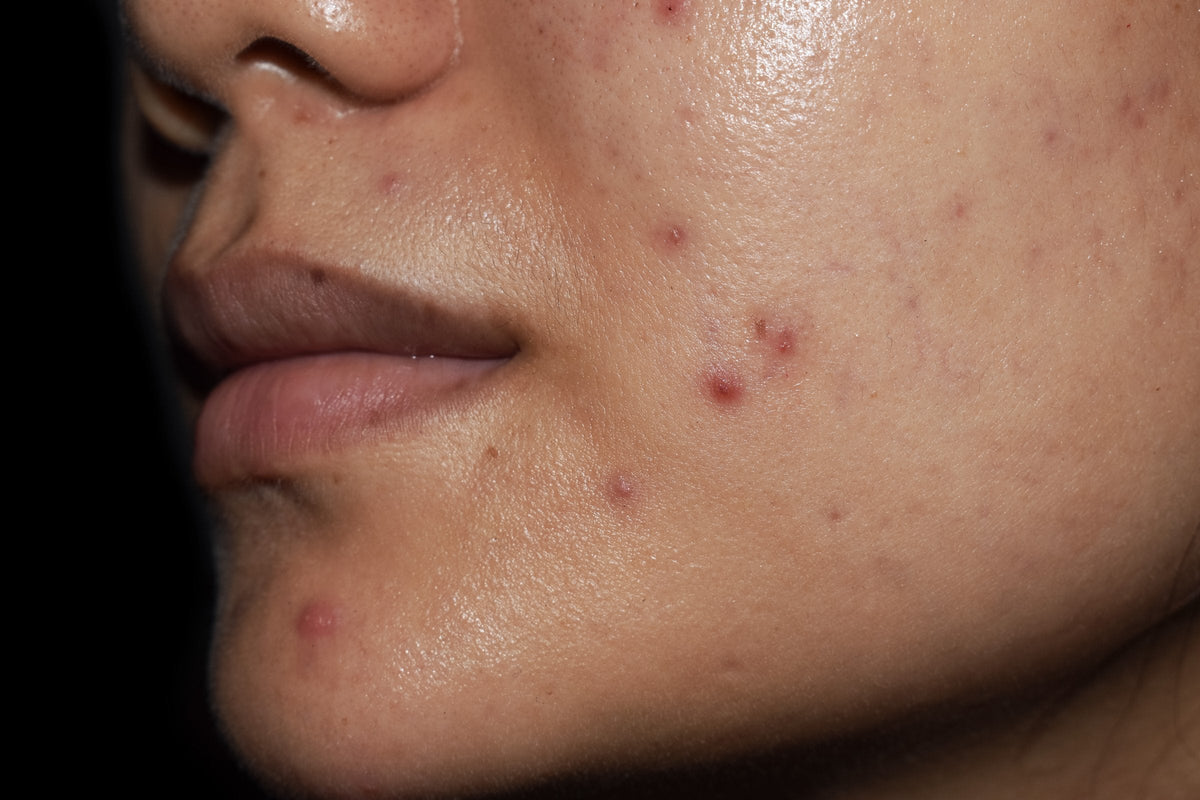 Three-quarter close-up of a woman's cheek and chin with scattered flat dark post-acne marks on medium-toned bare skin