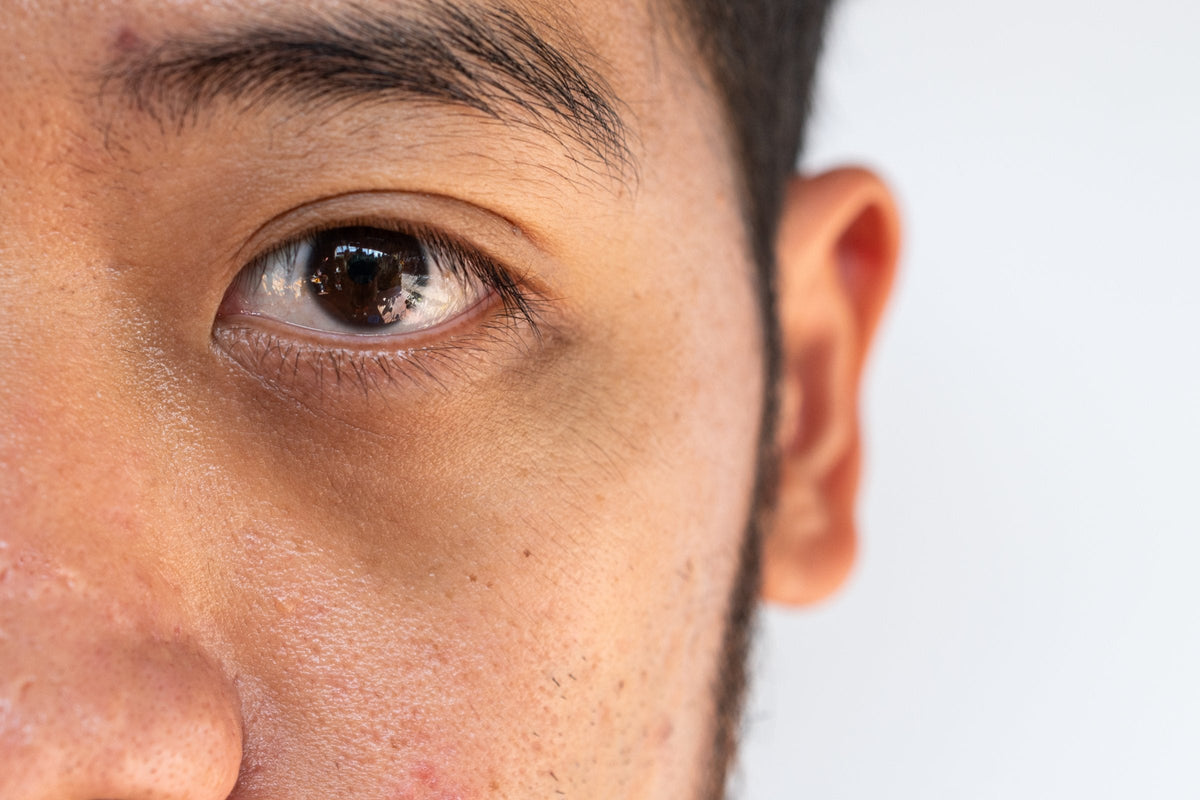 A man's eye in plain daylight with a dark shadow and mild puffiness beneath the lower lid, bare skin and no makeup