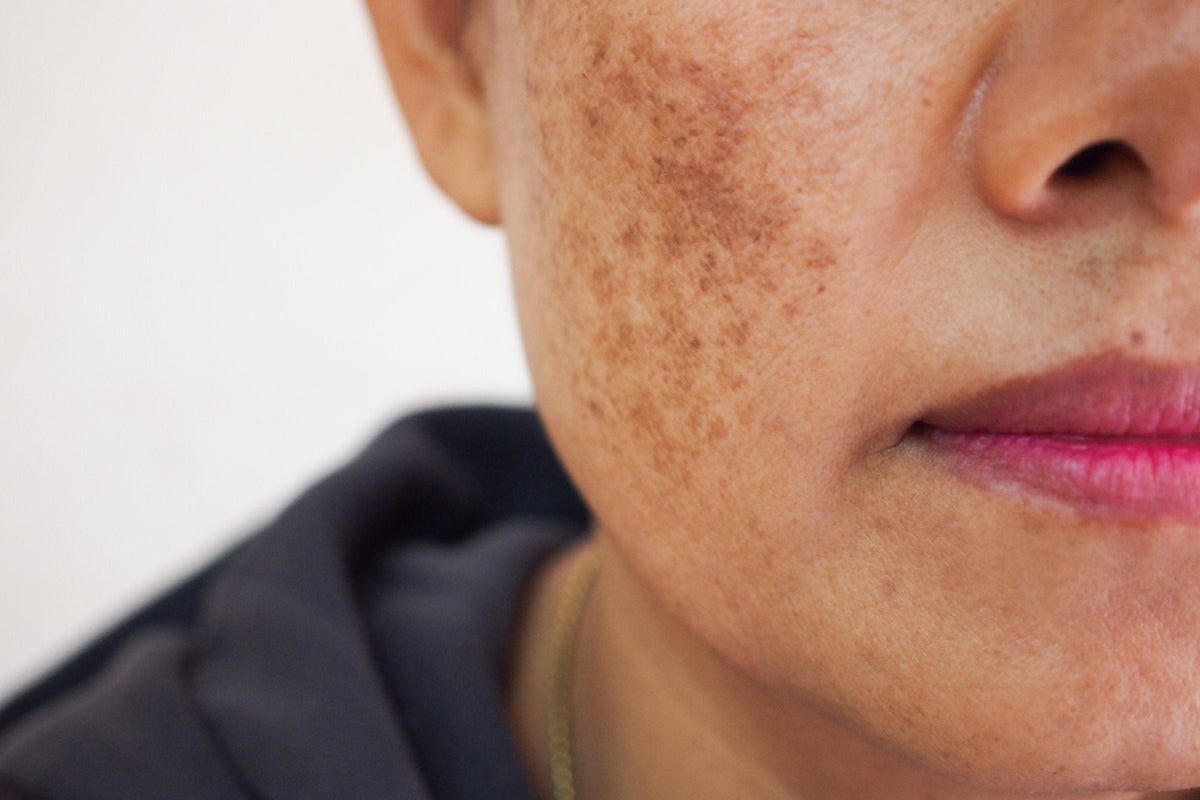 Close view of a woman's cheek with patches of melasma and dark spots
