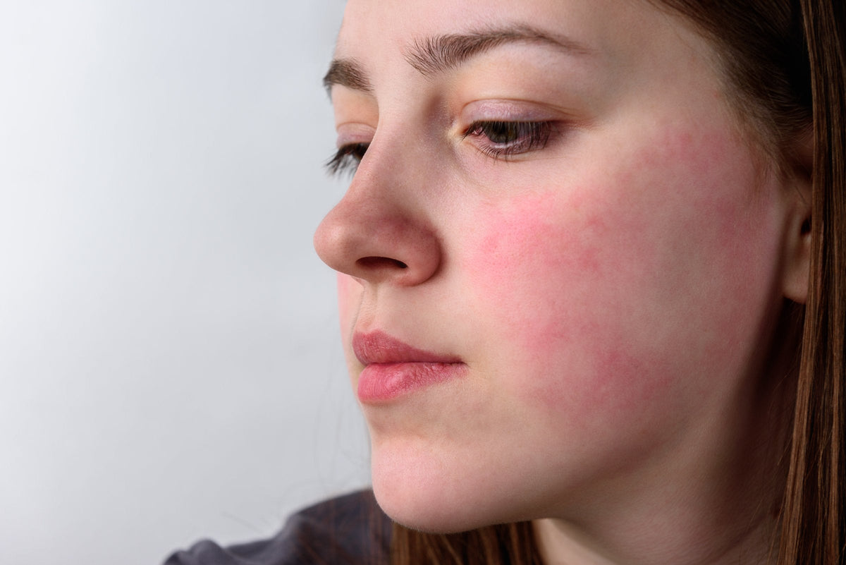 Close view of a young woman's cheek flushed red, in soft daylight