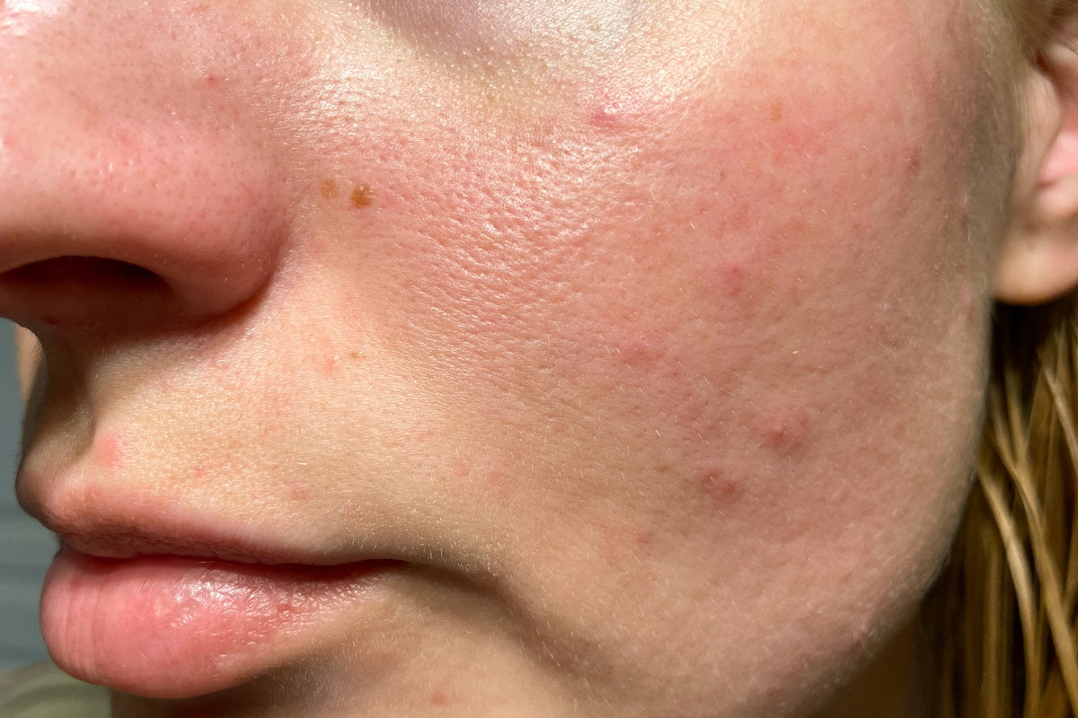 Close view of a woman's cheek with red, irritated skin and small bumps