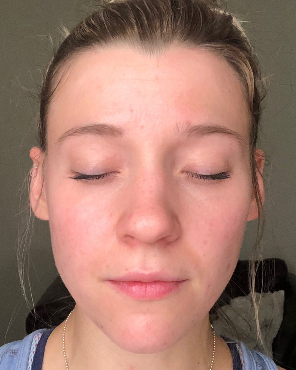 Kayla D. after 6 weeks using Wild Ice, acne and redness cleared