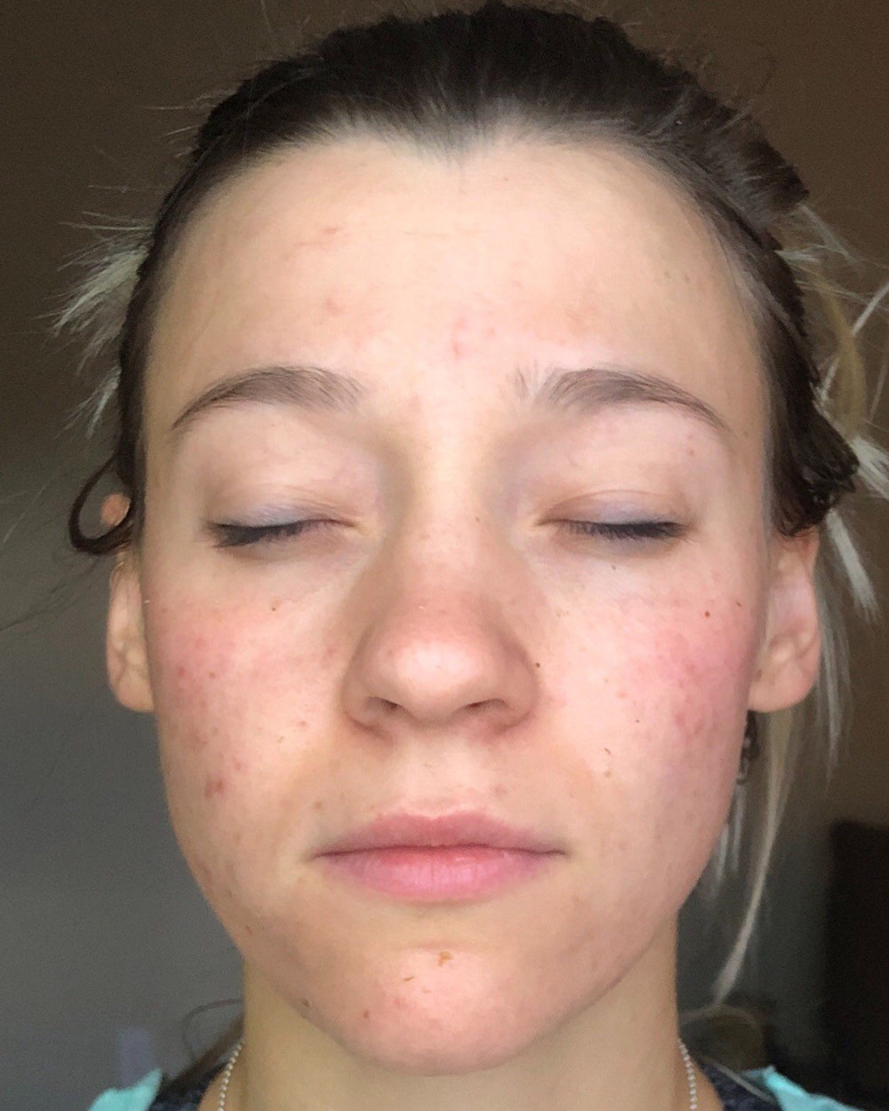 Kayla D. before Wild Ice, visible acne and redness