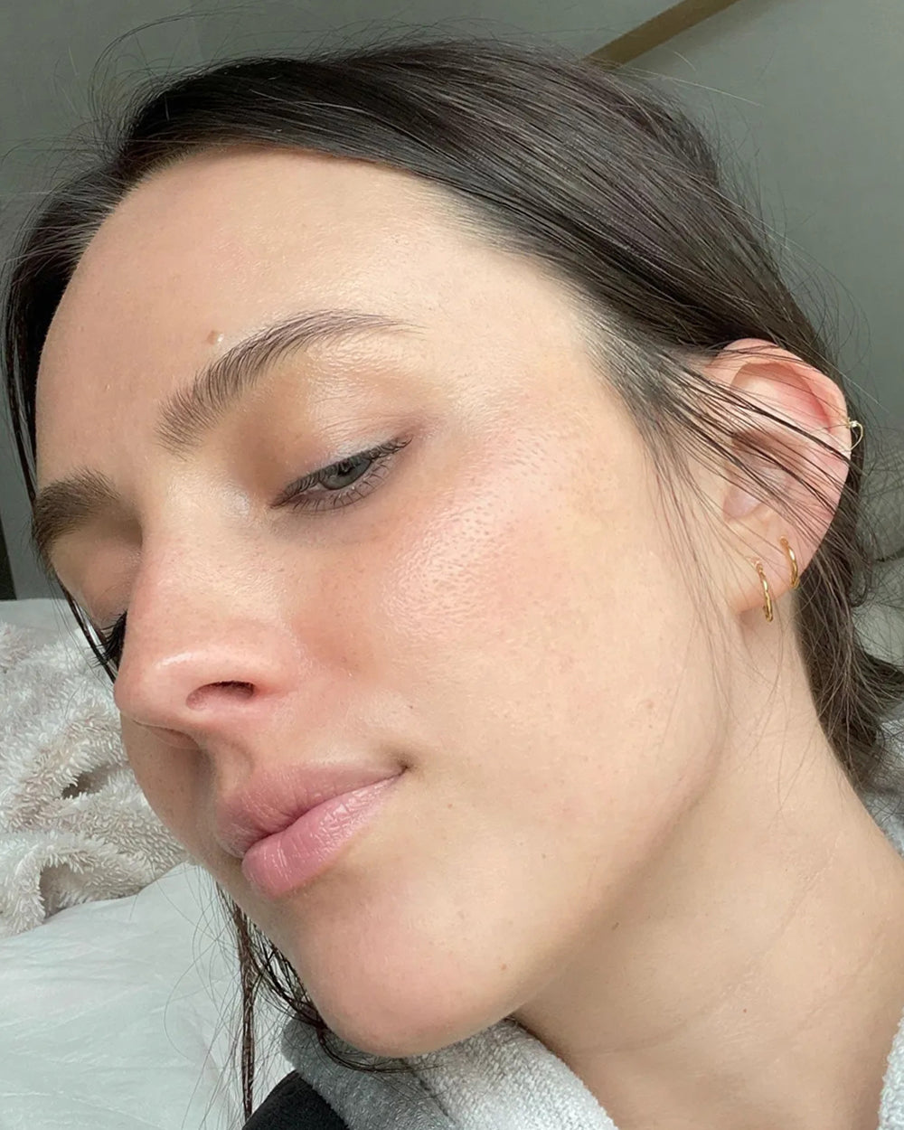 Mia E. after 3 months using Wild Ice, redness and inflammation resolved