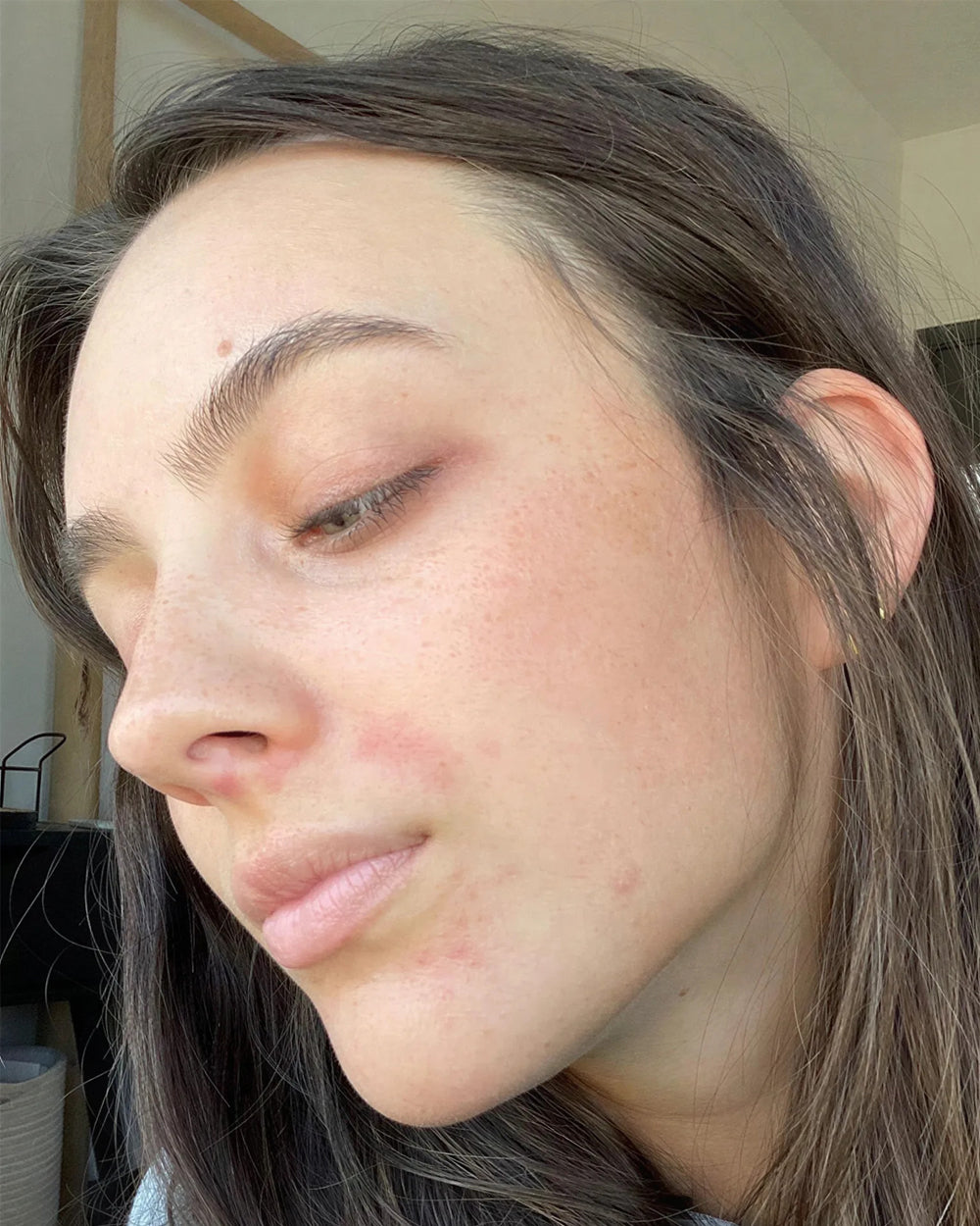 Mia E. before Wild Ice, visible redness and inflammation