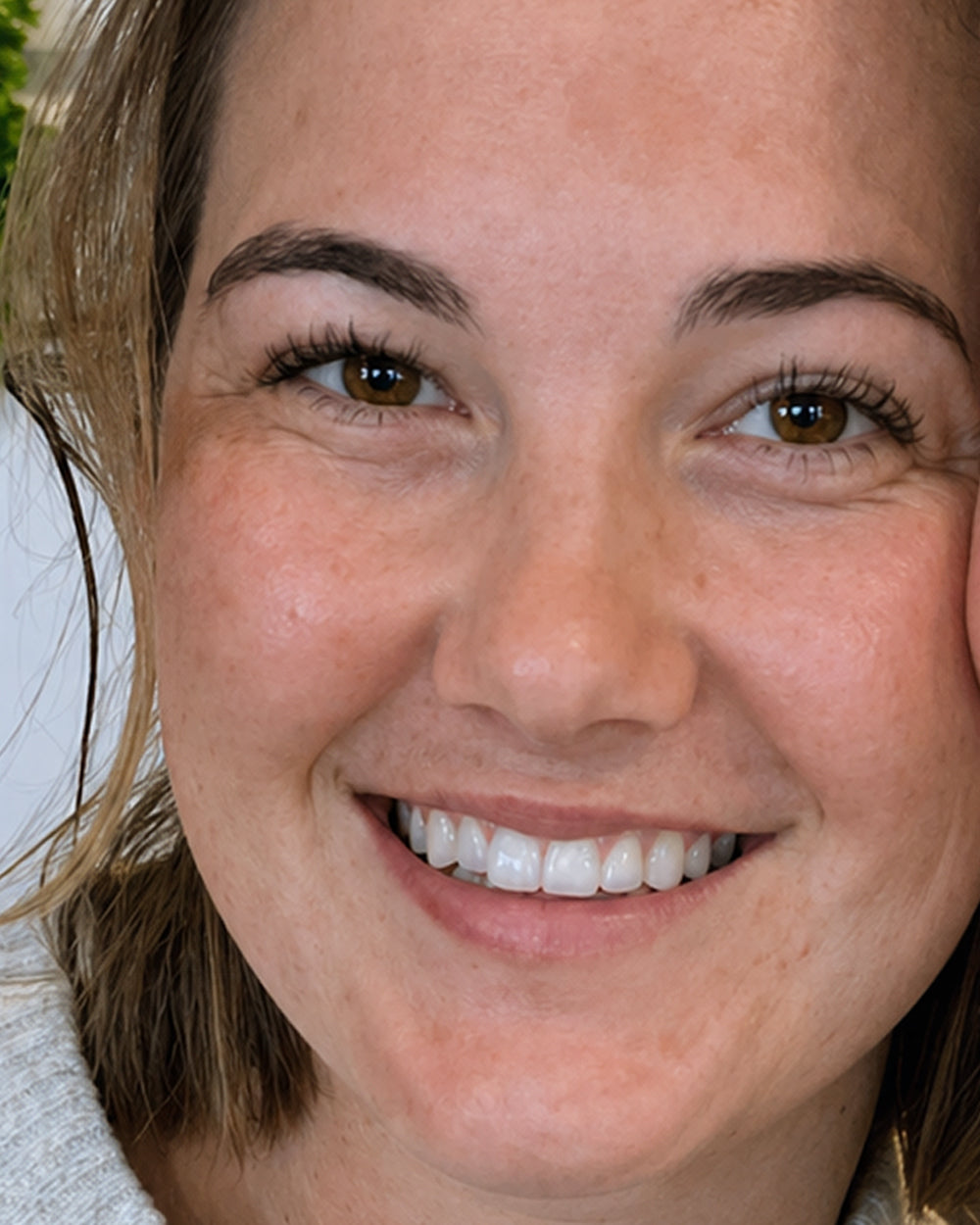 Nicole F. before, dark spots from post-injury scarring visible